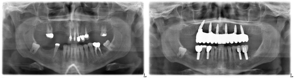 radiograph before and after